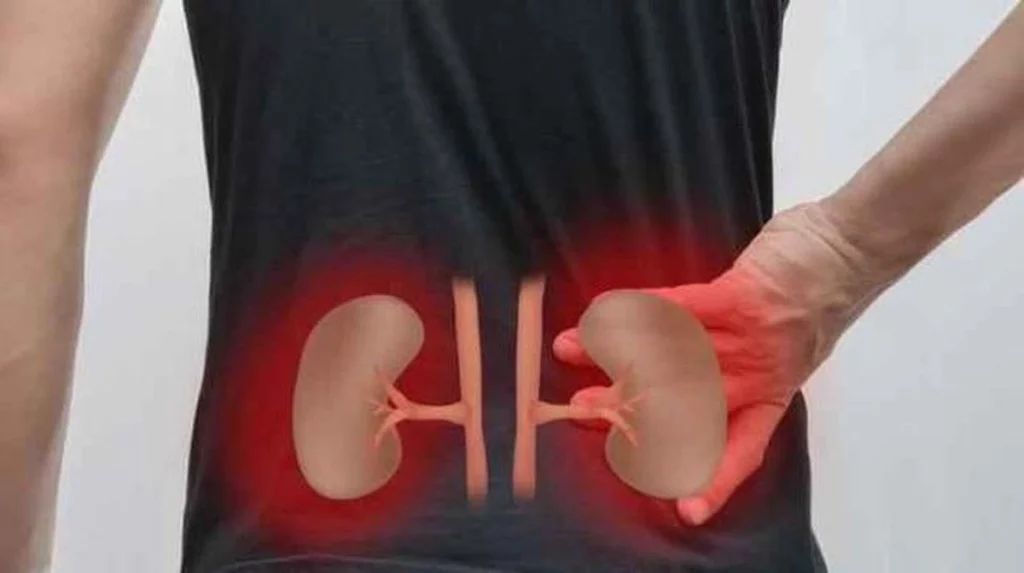 Nyeri Punggung? Waspada Kanker Ginjal